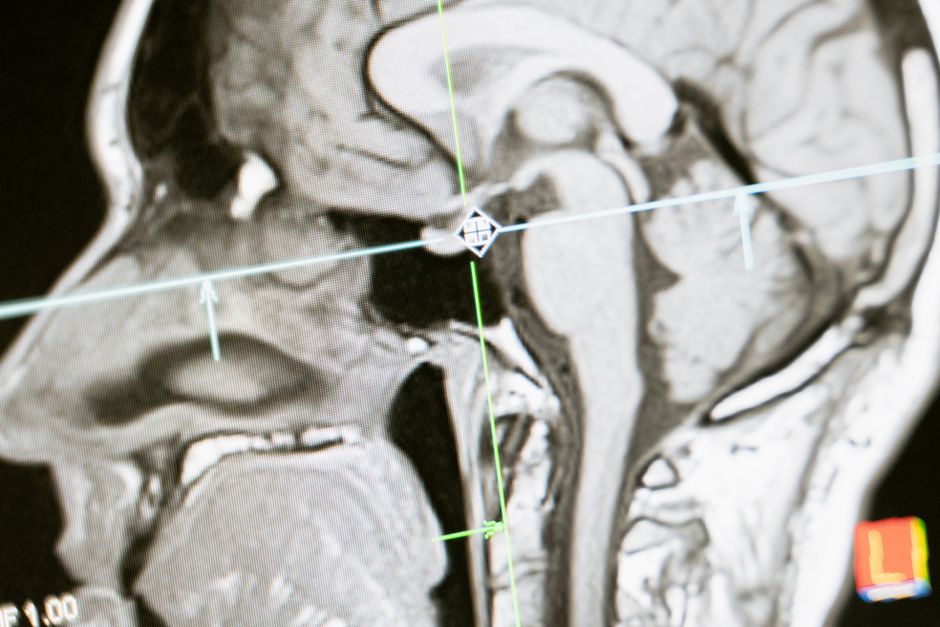 Neurological brain scan representing stroke prevention outcomes taught in the AF management diploma